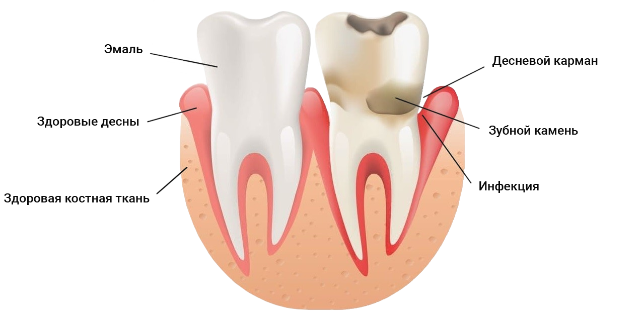 Лечение периодонтита зубов у детей